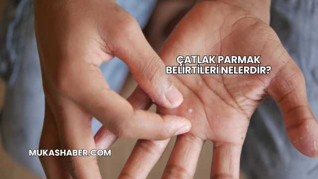 Çatlak Parmak Belirtileri Nelerdir?