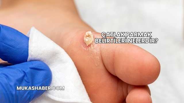 Çatlak Parmak Belirtileri Nelerdir?