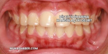 Diş Eti İltihabına Hangi İlaç İyi Gelir?