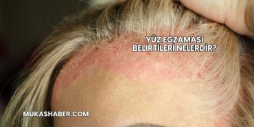 Yüz Egzaması Belirtileri Nelerdir?