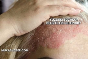 Yüzdeki Egzama Belirtileri Nelerdir?