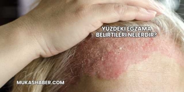 Yüzdeki Egzama Belirtileri Nelerdir?