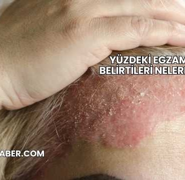 Yüzdeki Egzama Belirtileri Nelerdir?