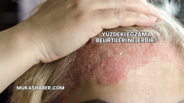 Yüzdeki Egzama Belirtileri Nelerdir?
