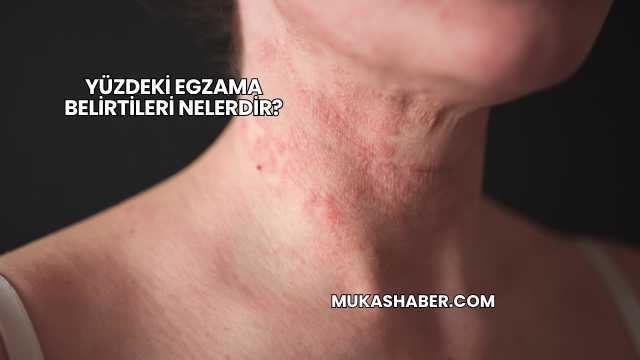 Yüzdeki Egzama Belirtileri Nelerdir?